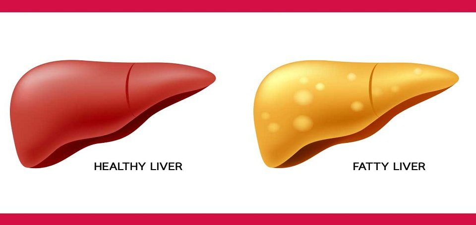Fatty liver best treatment in Ayurveda